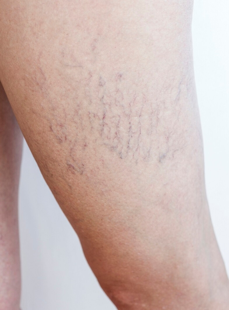 What are Spider Veins? — The Leg Vein Doctor, Brisbane