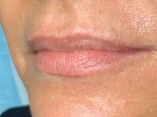 Lip Fillers Gold Coast Brisbane