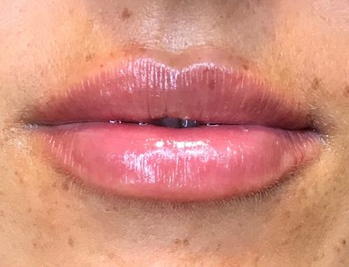 Lip Fillers Gold Coast Brisbane