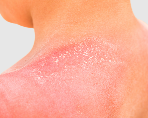 Sun-Damaged Skin Treatment: Your Options in Queensland