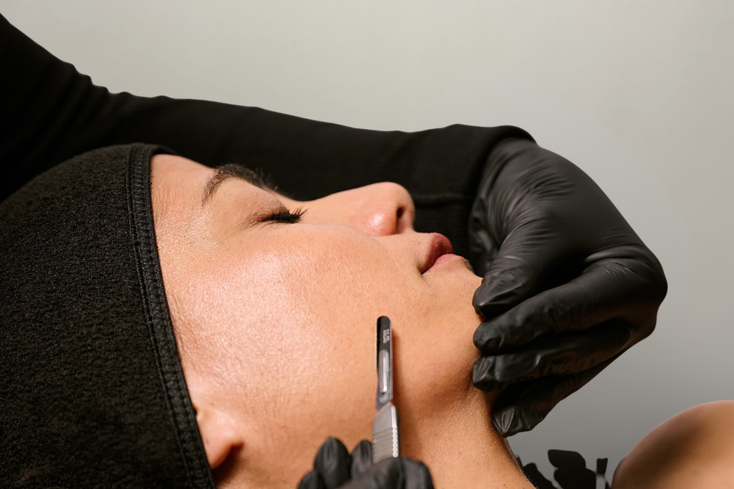 Epiblading Treatment by Esteem Clinic