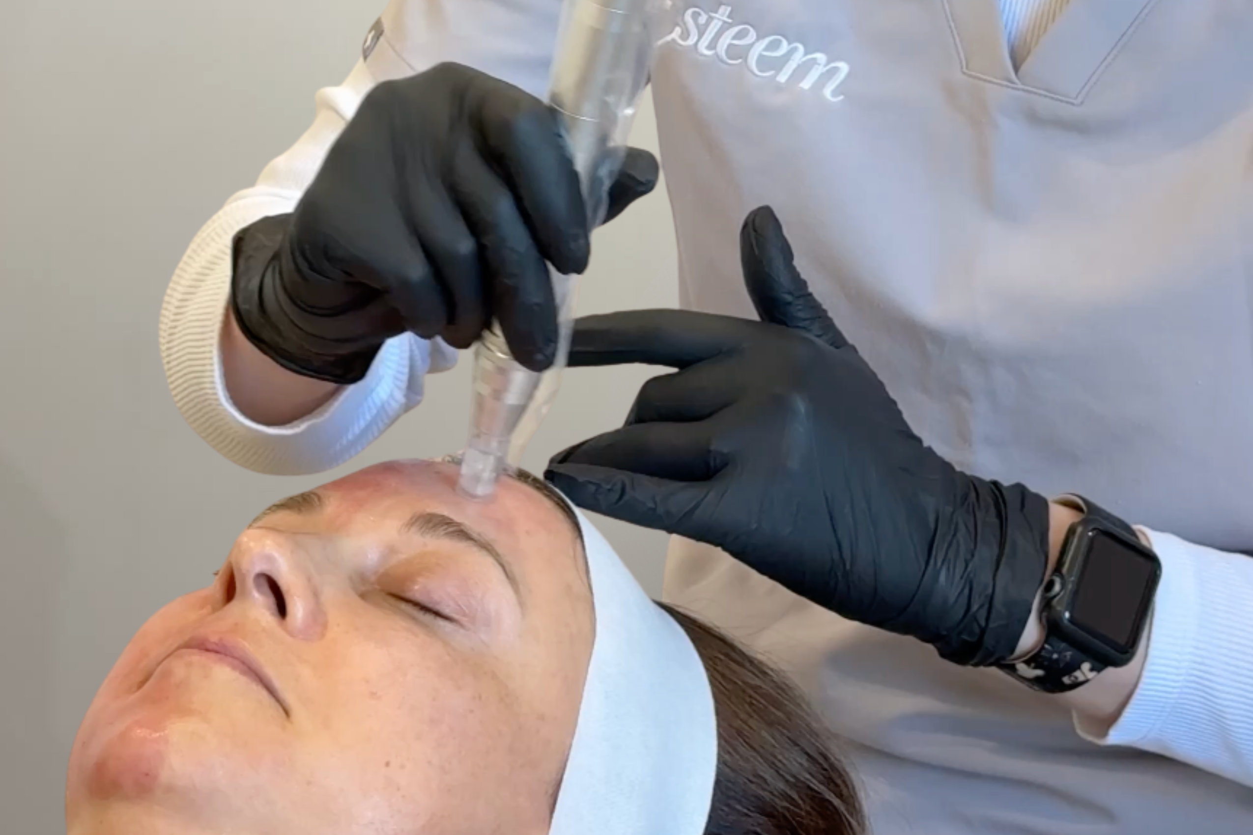PRP Skin Needling Esteem Clinic