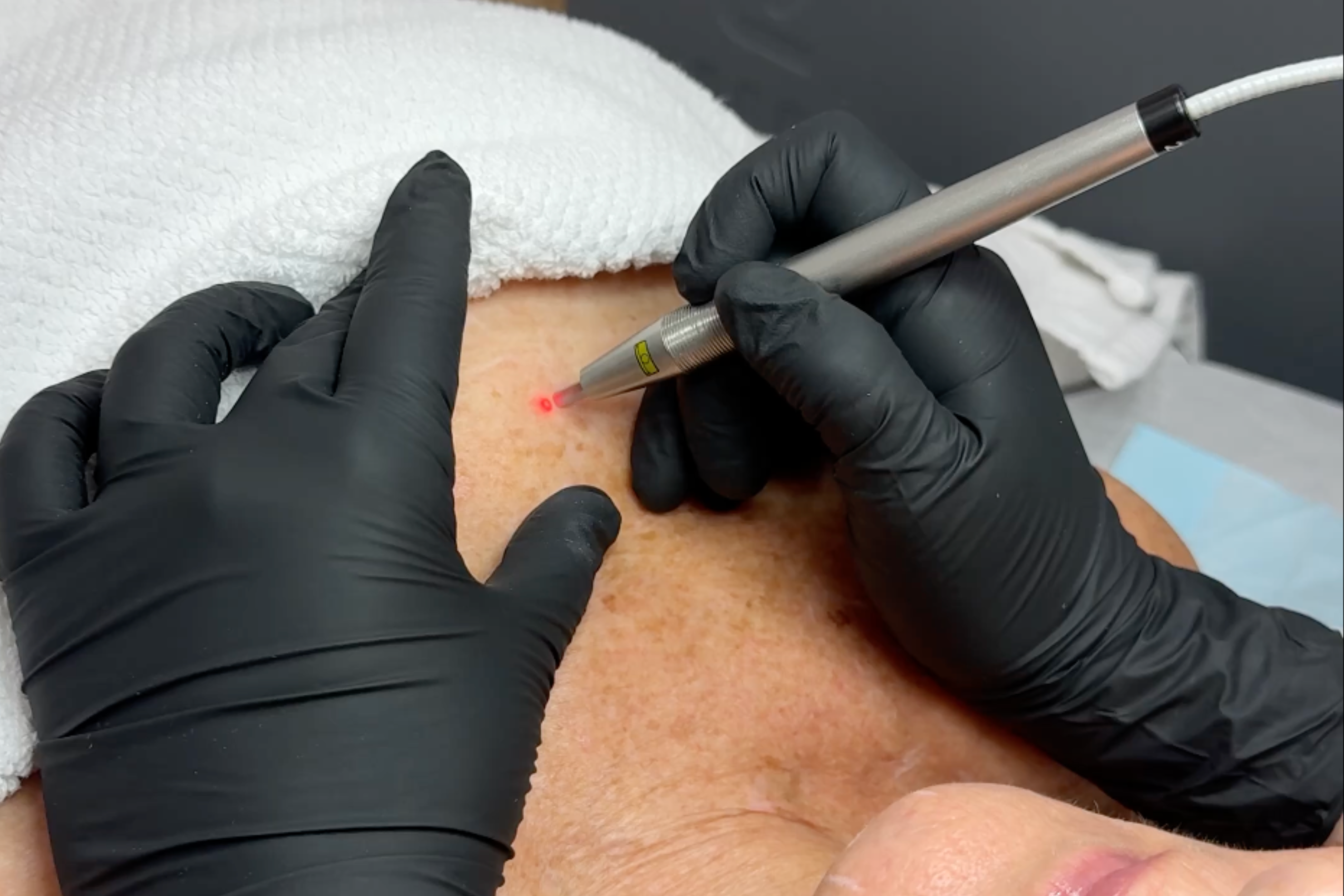 PICO Genesis Laser Treatment Esteem Clinic