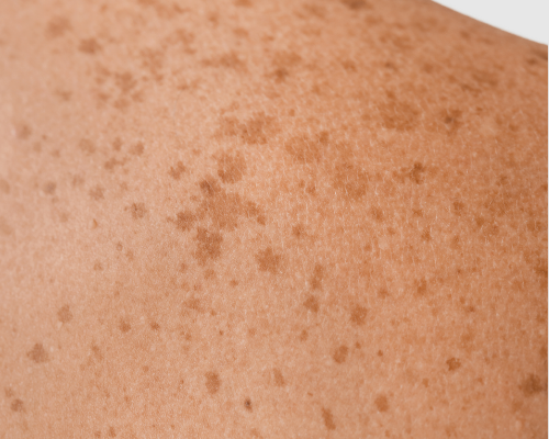 Skin treatments for sun-damaged skin