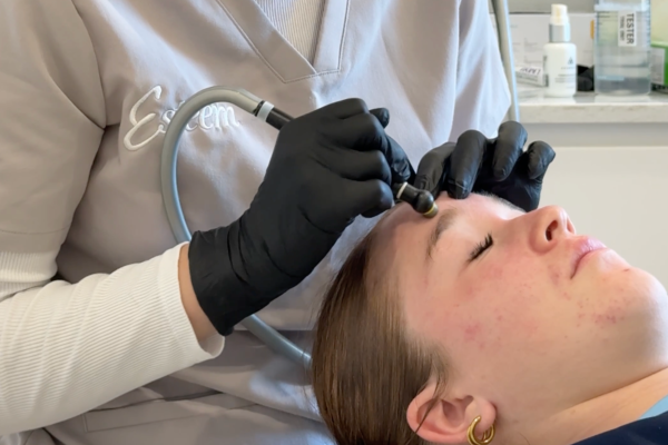 Microdermabrasion Skin Treatment Esteem Clinic